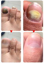 Charger l'image dans la galerie, Mooyam-Traitement anti-mycoses des ongles

