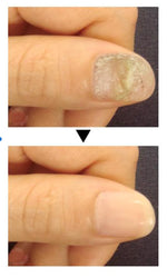 Charger l'image dans la galerie, Mooyam-Traitement anti-mycoses des ongles
